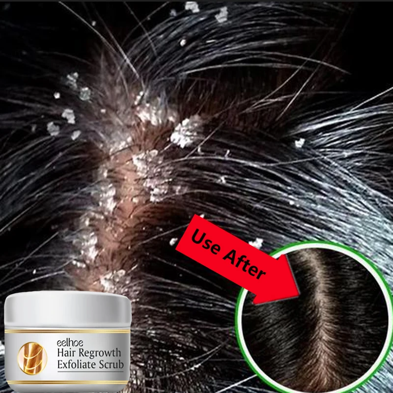 Scalp Scrub Exfoliant - 빠른 비듬 방지 헤어 트리트먼트 스크럽