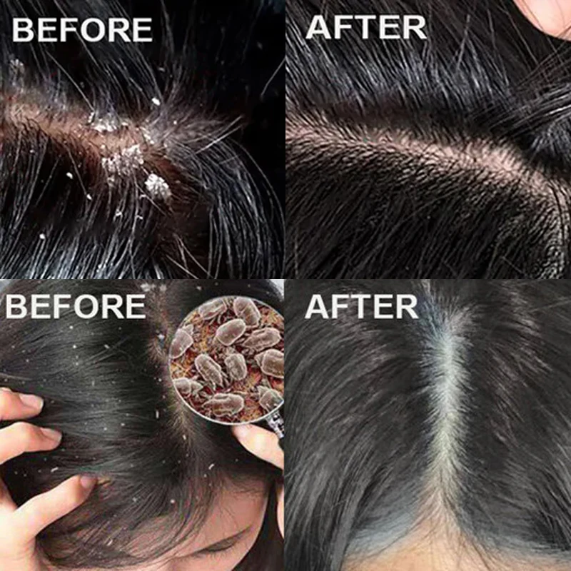 빠른 비듬 방지 헤어 트리트먼트 스크럽 가려움증 개선  - Scalp Scrub Exfoliant 리뷰 및 가격