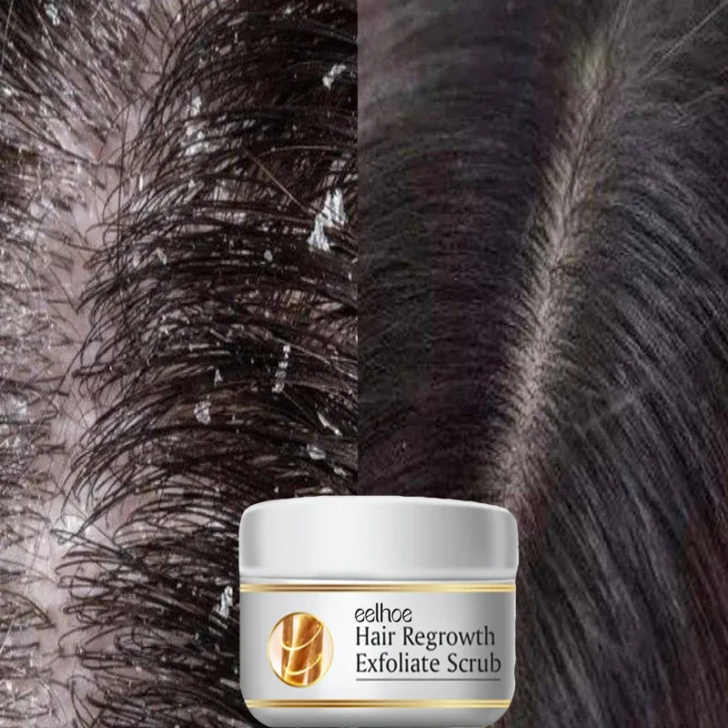 빠른 비듬 방지 헤어 트리트먼트 스크럽 가려움증 개선  - Scalp Scrub Exfoliant 리뷰 및 가격