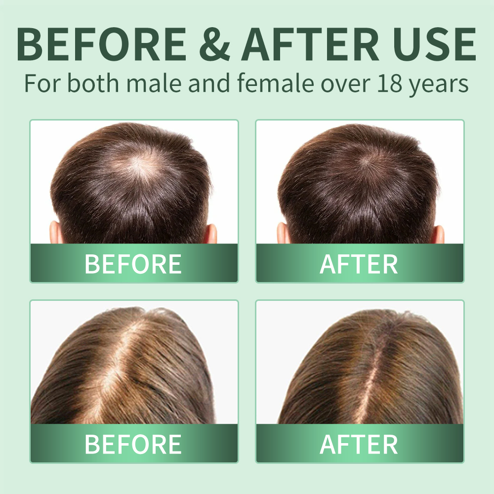 헤어 성장 스프레이, 두피 스크럽, 로즈마리 두피 각질 - Scalp Scrub Exfoliant 리뷰 및 가격